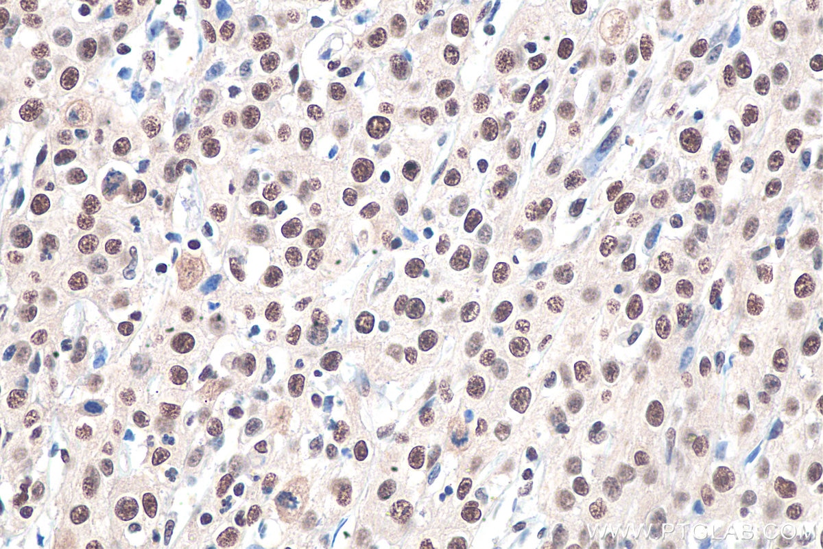 Immunohistochemistry (IHC) staining of human cervical cancer tissue using RBAP48 Polyclonal antibody (20364-1-AP)