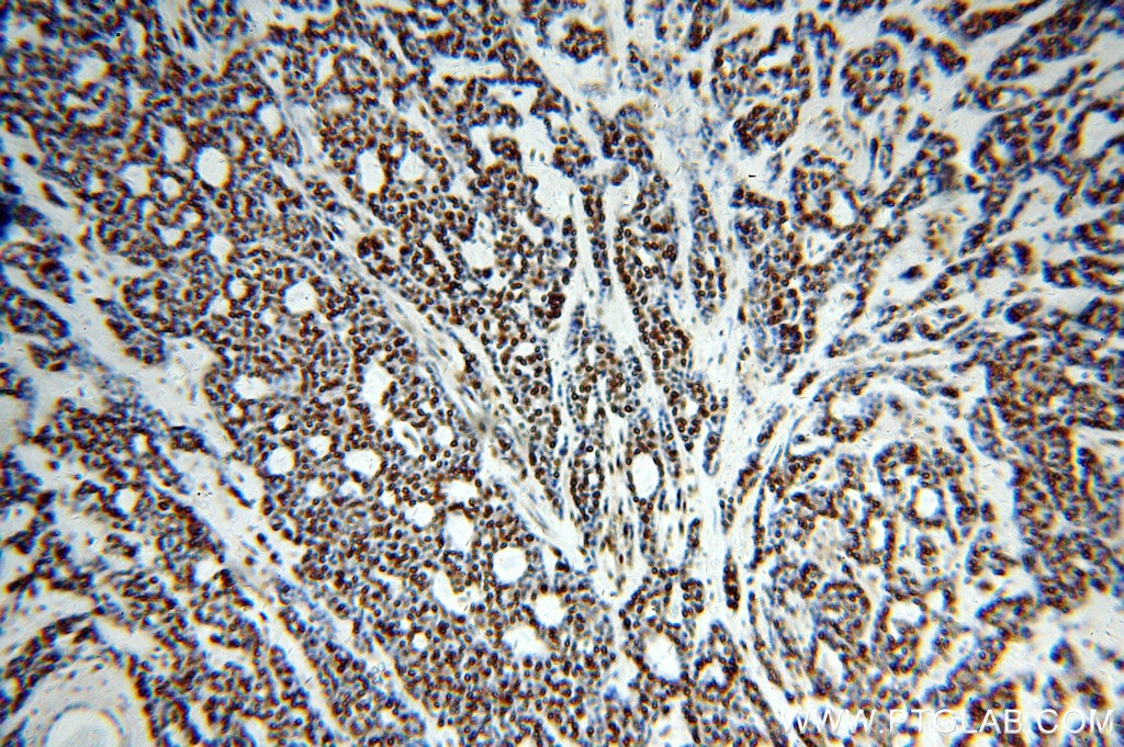 Immunohistochemistry (IHC) staining of human cervical cancer tissue using RBAP48 Polyclonal antibody (20364-1-AP)