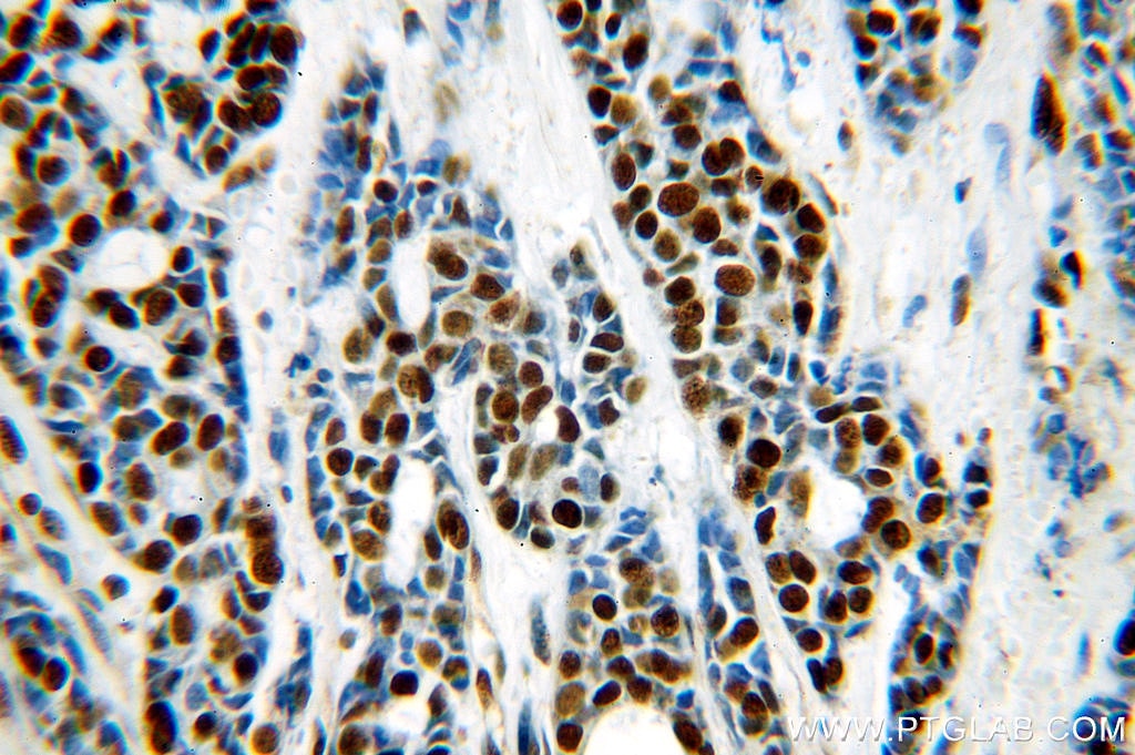 Immunohistochemistry (IHC) staining of human cervical cancer tissue using RBAP48 Polyclonal antibody (20364-1-AP)