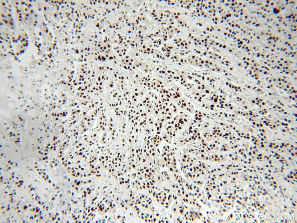 Immunohistochemistry (IHC) staining of human breast cancer tissue using RBAP48 Polyclonal antibody (20364-1-AP)