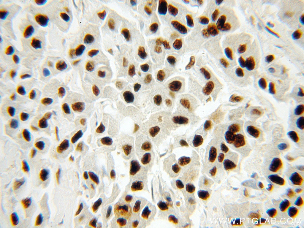 Immunohistochemistry (IHC) staining of human breast cancer tissue using RBAP48 Polyclonal antibody (20364-1-AP)