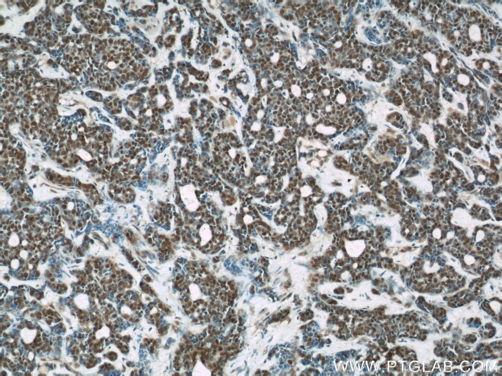 Immunohistochemistry (IHC) staining of human cervical cancer tissue using RBAP48 Monoclonal antibody (66060-1-Ig)