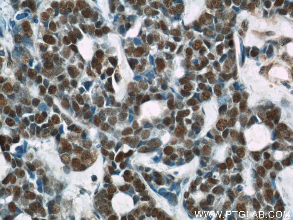 Immunohistochemistry (IHC) staining of human cervical cancer tissue using RBAP48 Monoclonal antibody (66060-1-Ig)