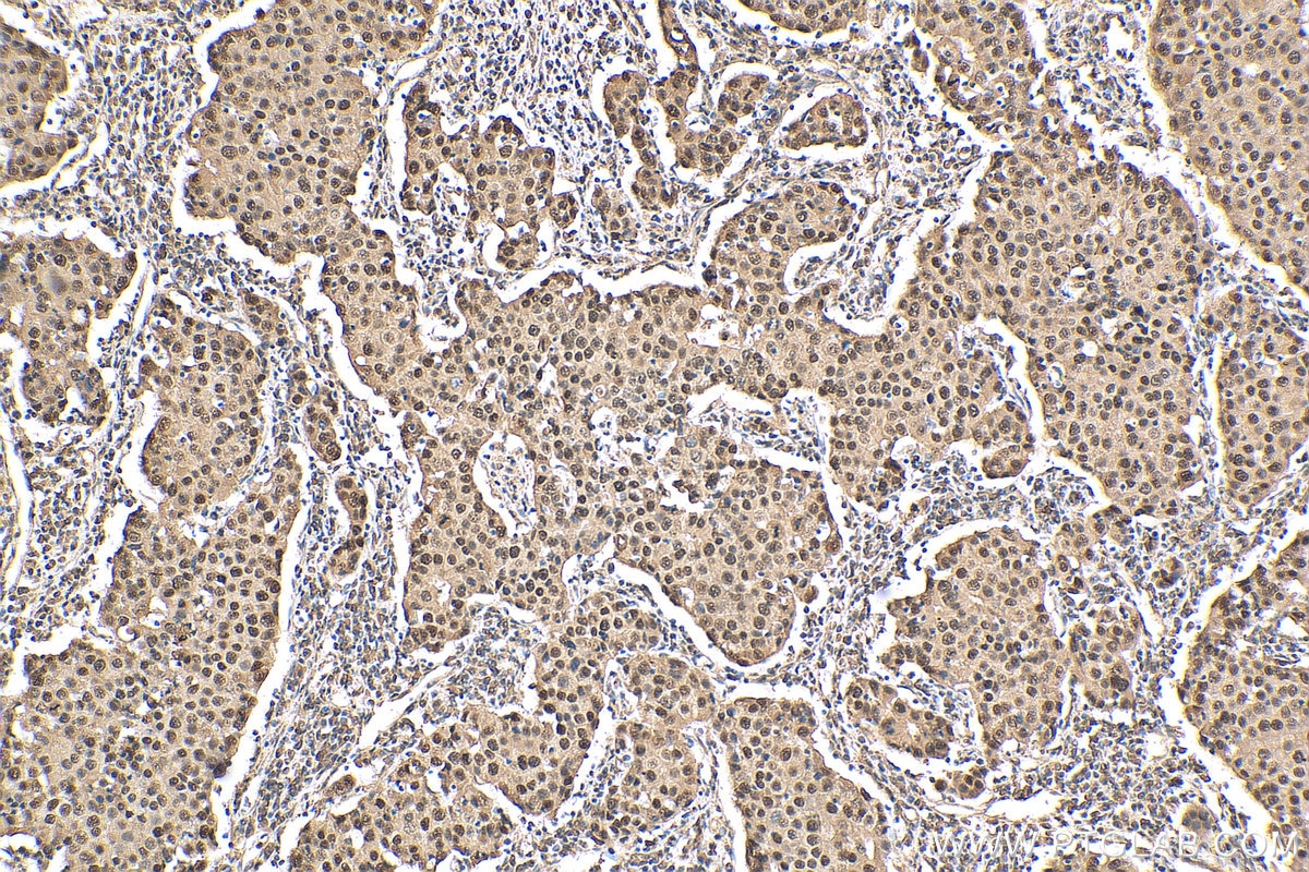 Immunohistochemistry (IHC) staining of human breast cancer tissue using RbAp46 Polyclonal antibody (20365-1-AP)
