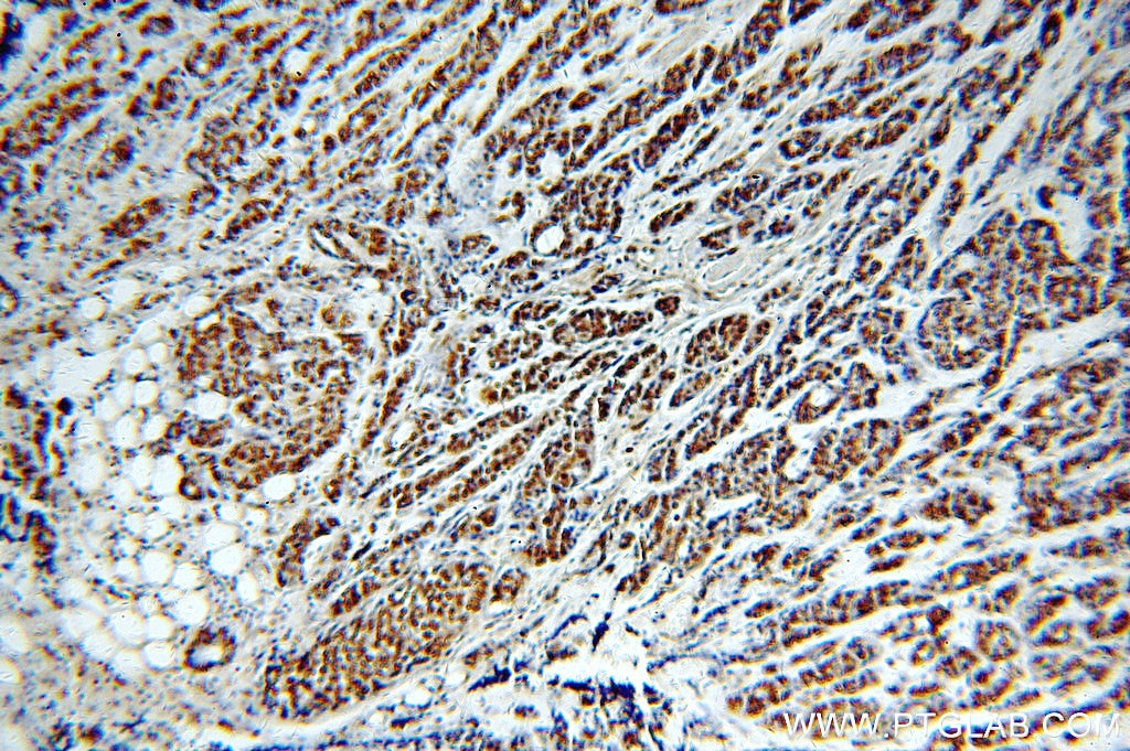 Immunohistochemistry (IHC) staining of human cervical cancer tissue using RbAp46 Polyclonal antibody (20365-1-AP)