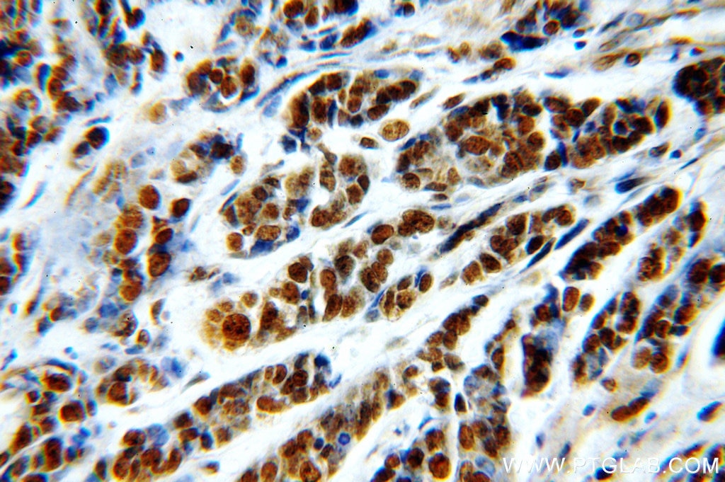 Immunohistochemistry (IHC) staining of human cervical cancer tissue using RbAp46 Polyclonal antibody (20365-1-AP)