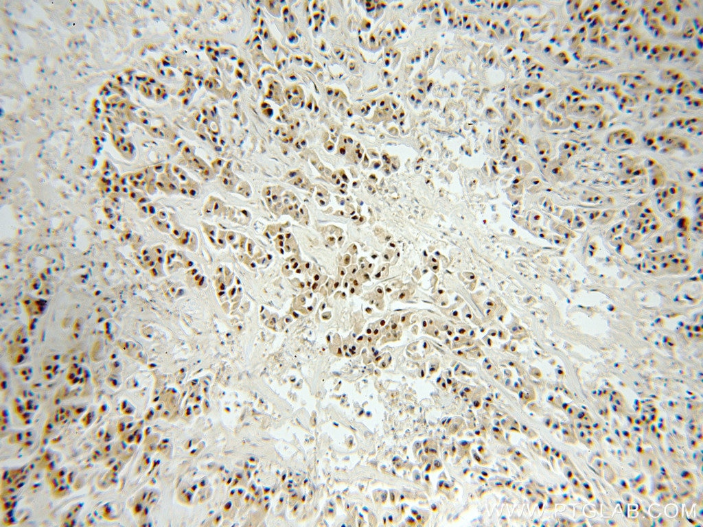 Immunohistochemistry (IHC) staining of human breast cancer tissue using RbAp46 Polyclonal antibody (20365-1-AP)