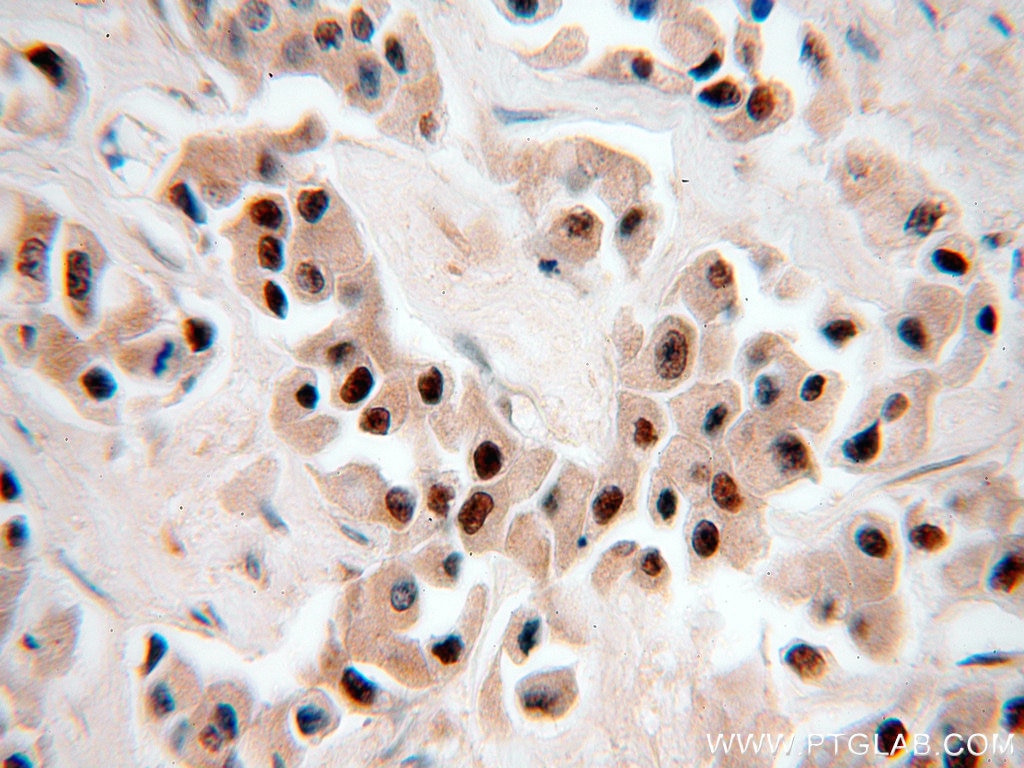 Immunohistochemistry (IHC) staining of human breast cancer tissue using RbAp46 Polyclonal antibody (20365-1-AP)