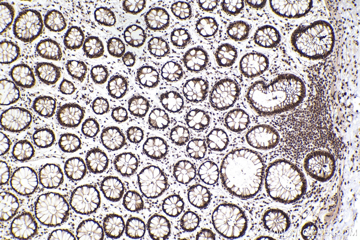 Immunohistochemistry (IHC) staining of human rectal cancer tissue using RBBP7 Recombinant antibody (84330-1-RR)