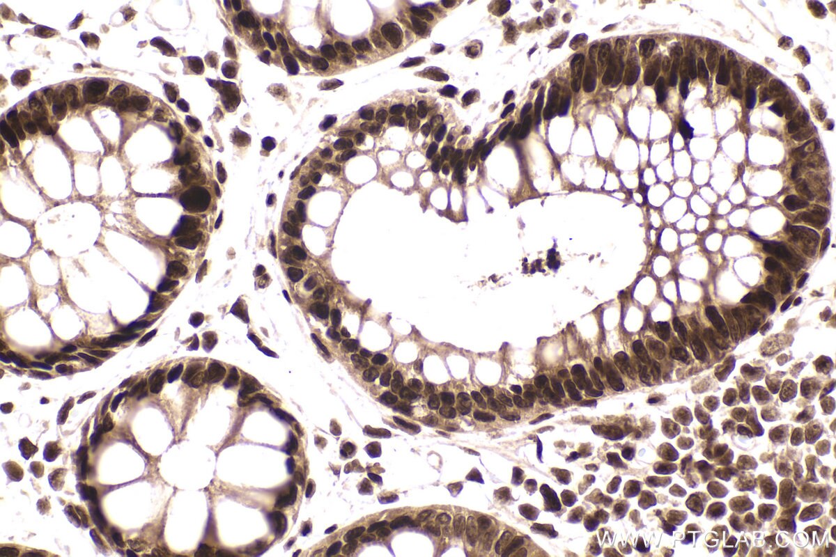 Immunohistochemistry (IHC) staining of human rectal cancer tissue using RBBP7 Recombinant antibody (84330-1-RR)