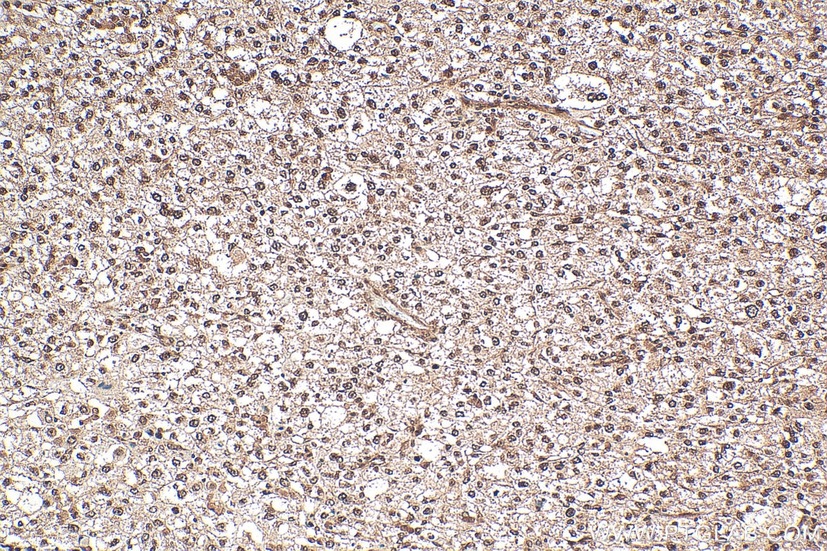 IHC staining of human pancreas cancer using 12230-2-AP Immunohistochemistry (IHC) staining of human pancreas cancer tissue using RBBP9 Polyclonal antibody (12230-2-AP)