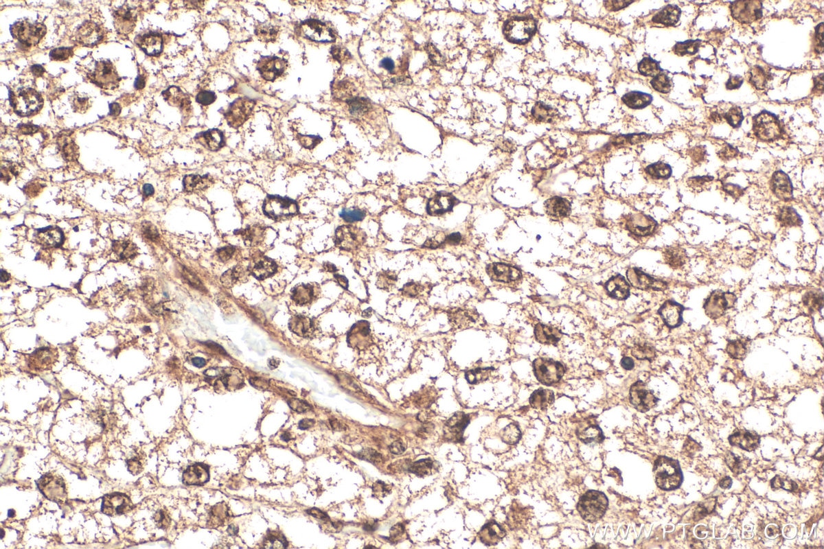 IHC staining of human pancreas cancer using 12230-2-AP Immunohistochemistry (IHC) staining of human pancreas cancer tissue using RBBP9 Polyclonal antibody (12230-2-AP)