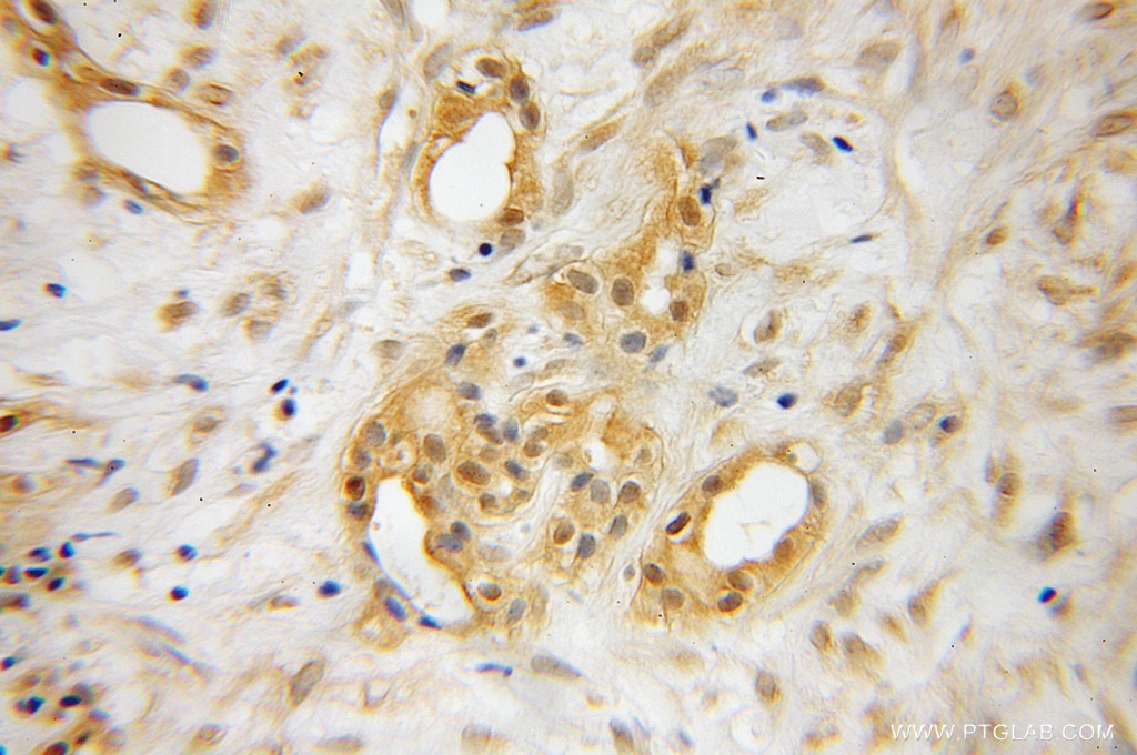 Immunohistochemistry (IHC) staining of human pancreas cancer tissue using RBBP9 Polyclonal antibody (12230-2-AP)