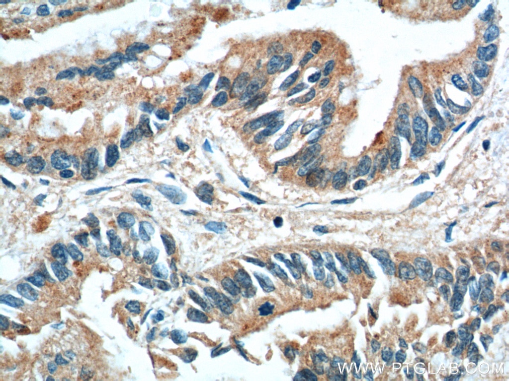 Immunohistochemistry (IHC) staining of human pancreas cancer tissue using RBBP9 Monoclonal antibody (66015-1-Ig)