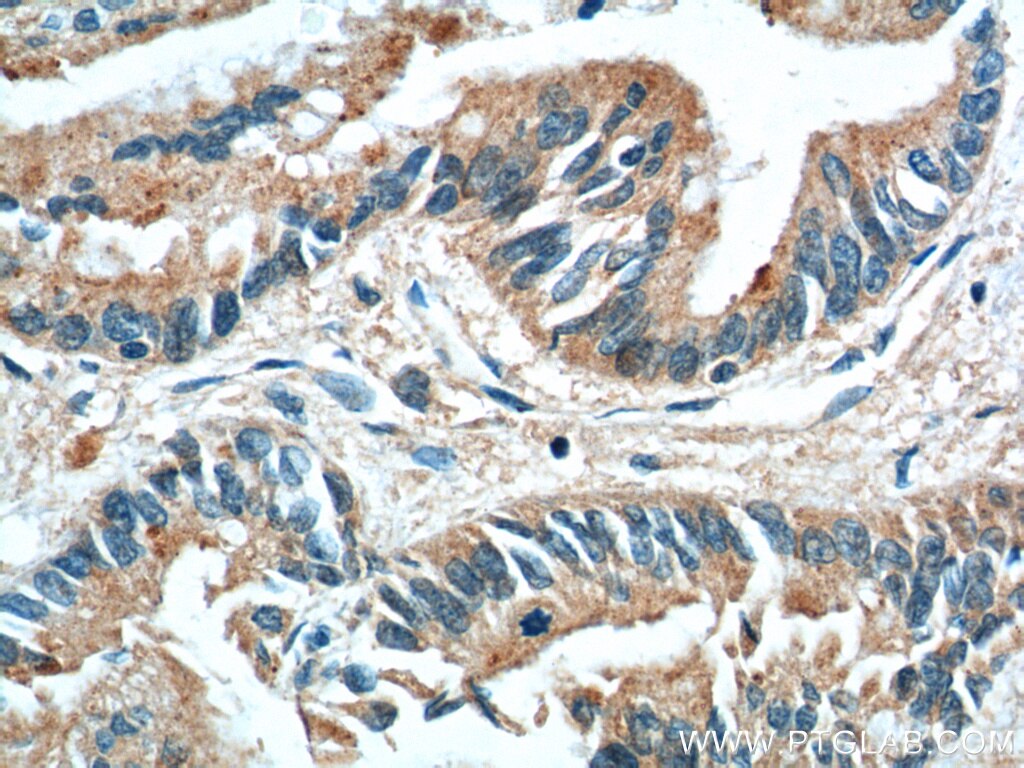 IHC staining of human pancreas cancer using 66015-1-Ig