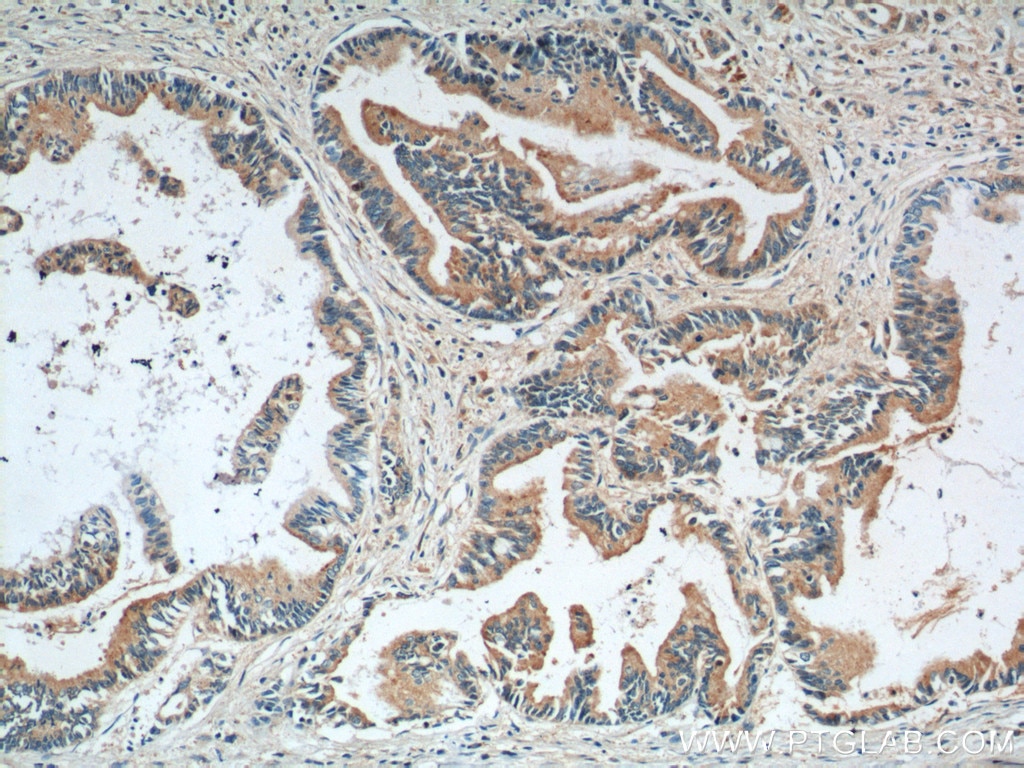 Immunohistochemistry (IHC) staining of human pancreas cancer tissue using RBBP9 Monoclonal antibody (66015-1-Ig)