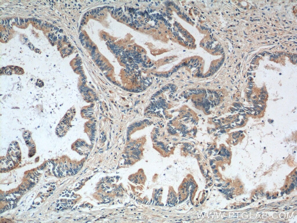Immunohistochemistry (IHC) staining of human pancreas cancer tissue using RBBP9 Monoclonal antibody (66015-2-Ig)