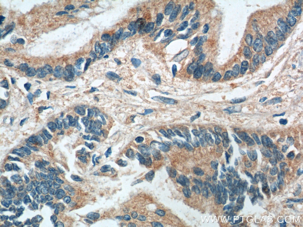 Immunohistochemistry (IHC) staining of human pancreas cancer tissue using RBBP9 Monoclonal antibody (66015-2-Ig)