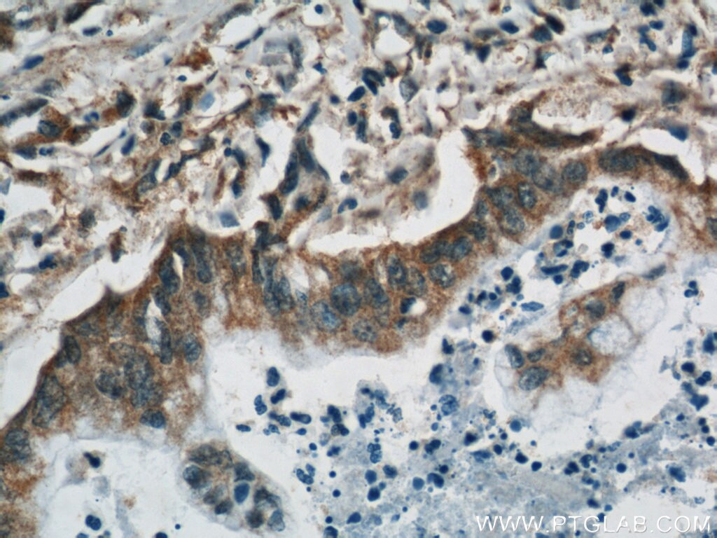 Immunohistochemistry (IHC) staining of human pancreas cancer tissue using RBBP9 Monoclonal antibody (66015-2-Ig)