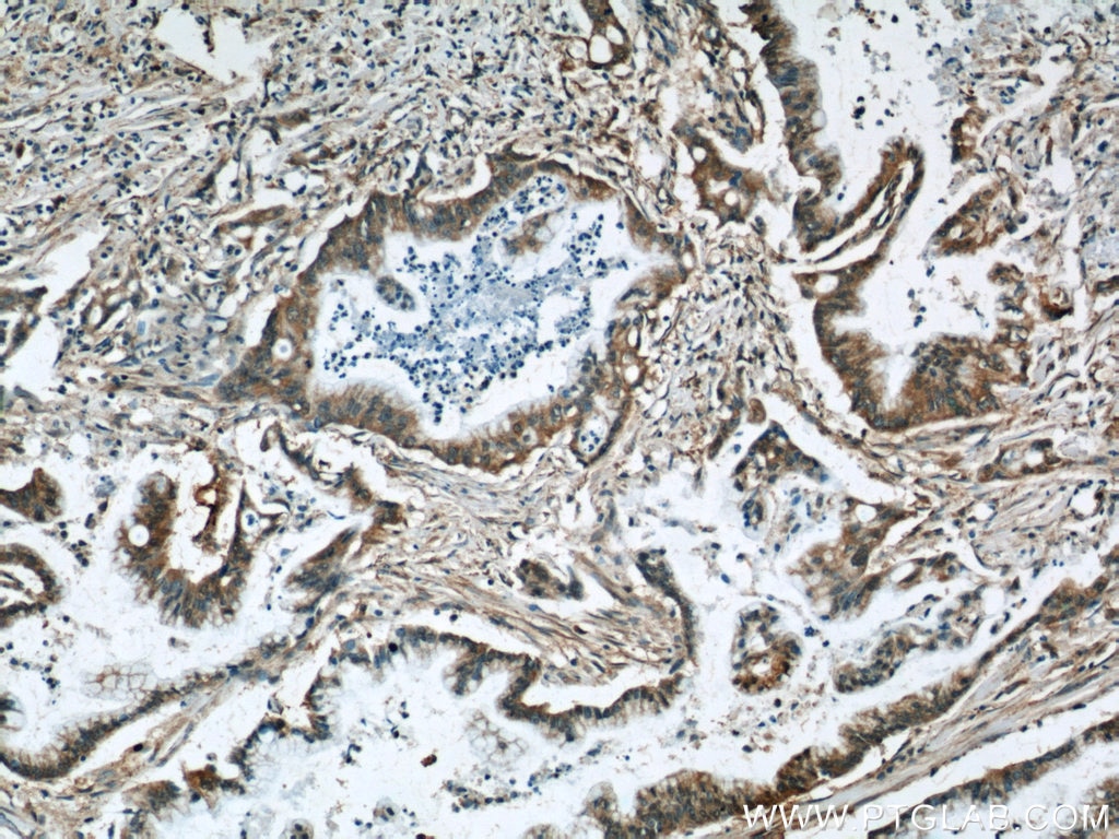 Immunohistochemistry (IHC) staining of human pancreas cancer tissue using RBBP9 Monoclonal antibody (66015-2-Ig)