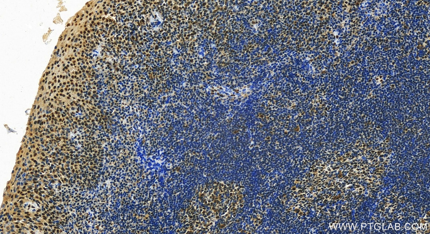 Immunohistochemistry (IHC) staining of human tonsillitis tissue using RBM12 Polyclonal antibody (30990-1-AP)