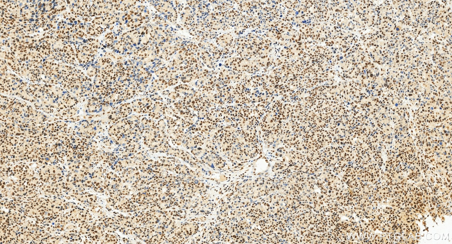 IHC staining of human stomach cancer using 10196-1-AP Immunohistochemistry (IHC) staining of human stomach cancer tissue using RBM14 Polyclonal antibody (10196-1-AP)