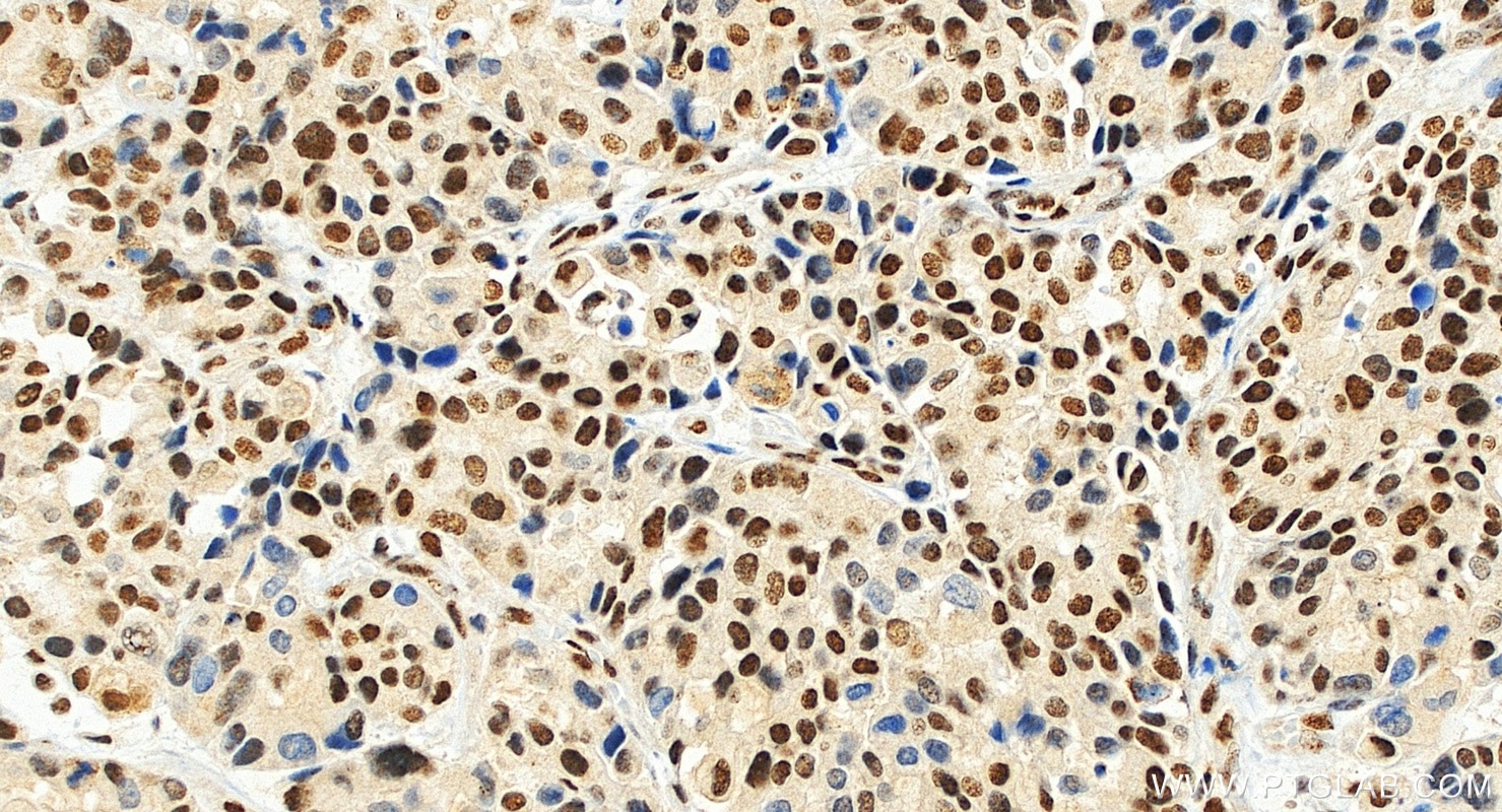 IHC staining of human stomach cancer using 10196-1-AP Immunohistochemistry (IHC) staining of human stomach cancer tissue using RBM14 Polyclonal antibody (10196-1-AP)