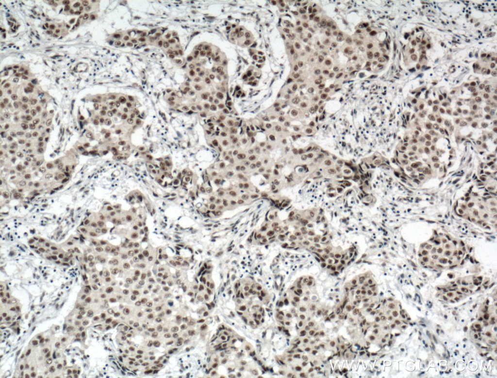 Immunohistochemistry (IHC) staining of human breast cancer tissue using RBM15 Polyclonal antibody (10587-1-AP)