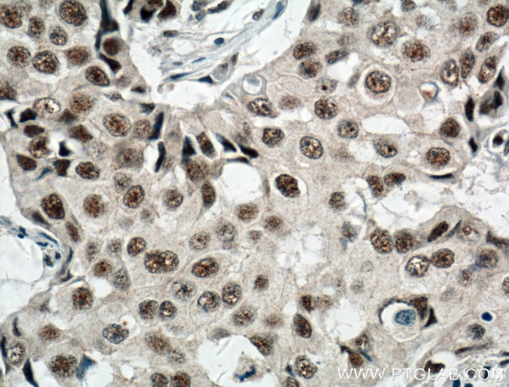 Immunohistochemistry (IHC) staining of human breast cancer tissue using RBM15 Polyclonal antibody (10587-1-AP)