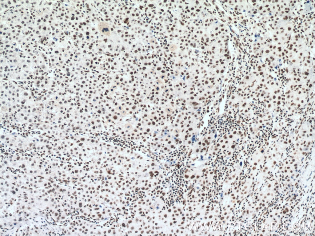 IHC staining of human liver cancer using 66059-1-Ig