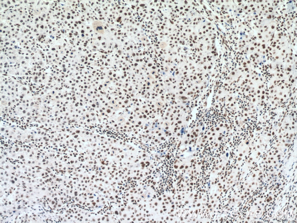 Immunohistochemistry (IHC) staining of human liver cancer tissue using RBM15 Monoclonal antibody (66059-1-Ig)