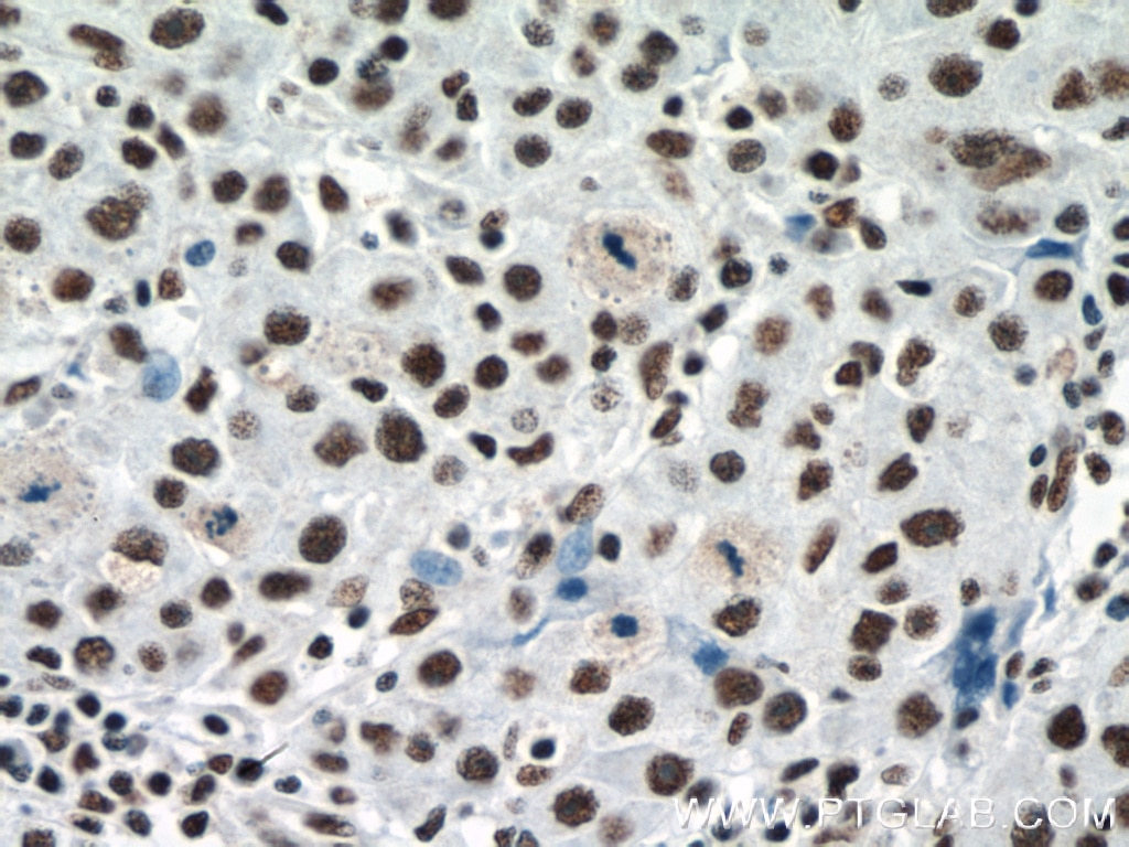 Immunohistochemistry (IHC) staining of human liver cancer tissue using RBM15 Monoclonal antibody (66059-1-Ig)