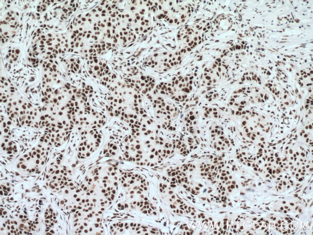 Immunohistochemistry (IHC) staining of human breast cancer tissue using RBM15 Monoclonal antibody (66059-1-Ig)