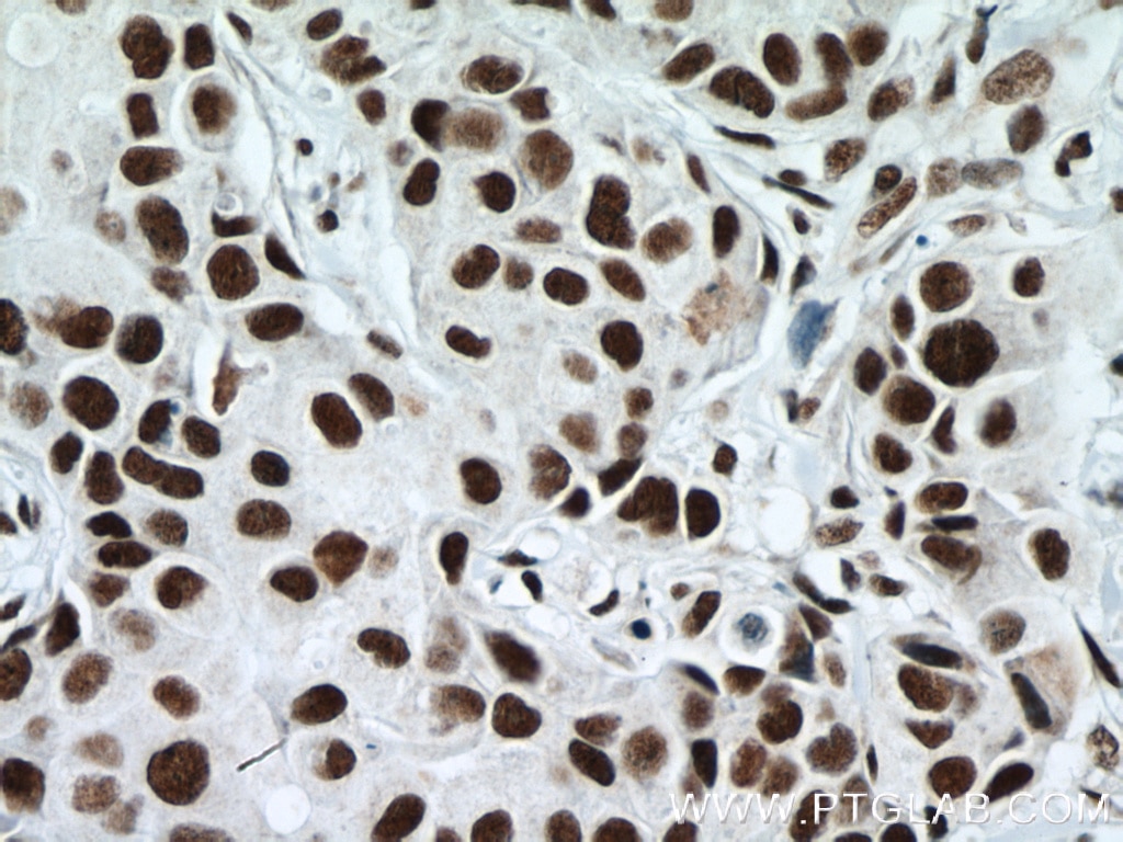 Immunohistochemistry (IHC) staining of human breast cancer tissue using RBM15 Monoclonal antibody (66059-1-Ig)