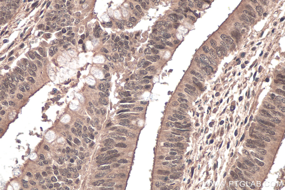 Immunohistochemistry (IHC) staining of human colon cancer tissue using RBM15B Monoclonal antibody (67506-1-Ig)