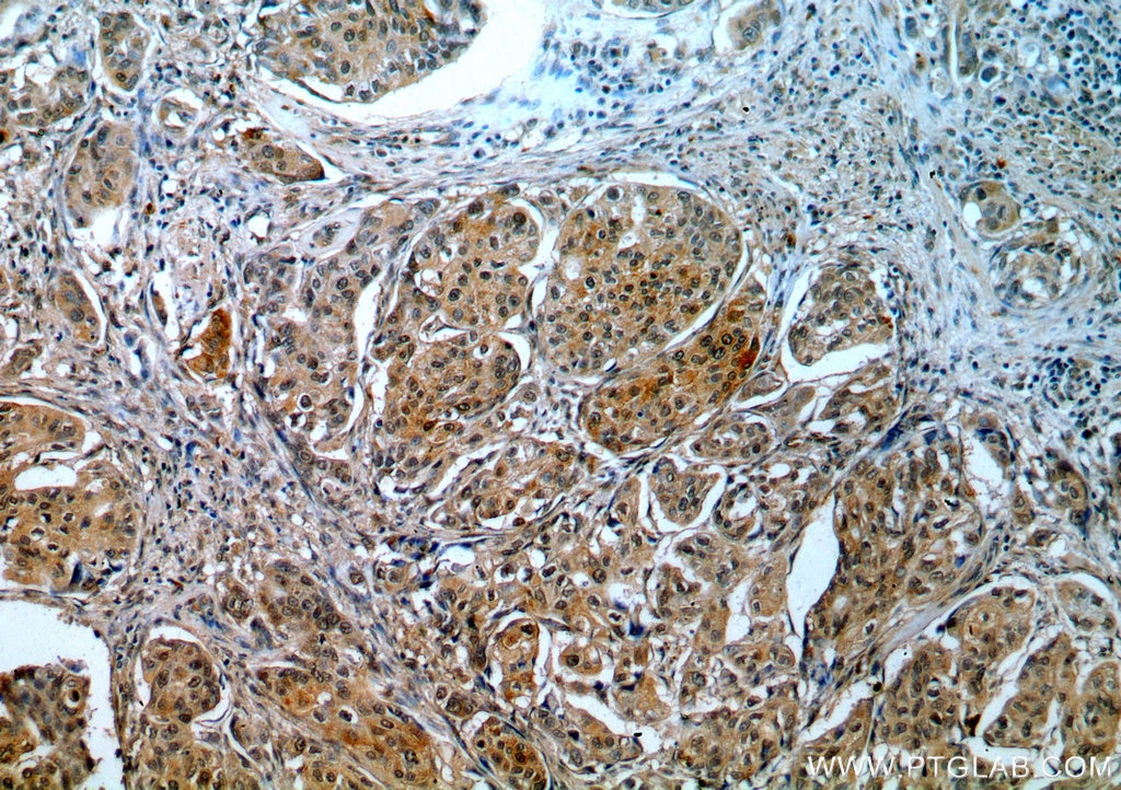 IHC staining of human cervical cancer using 18893-1-AP