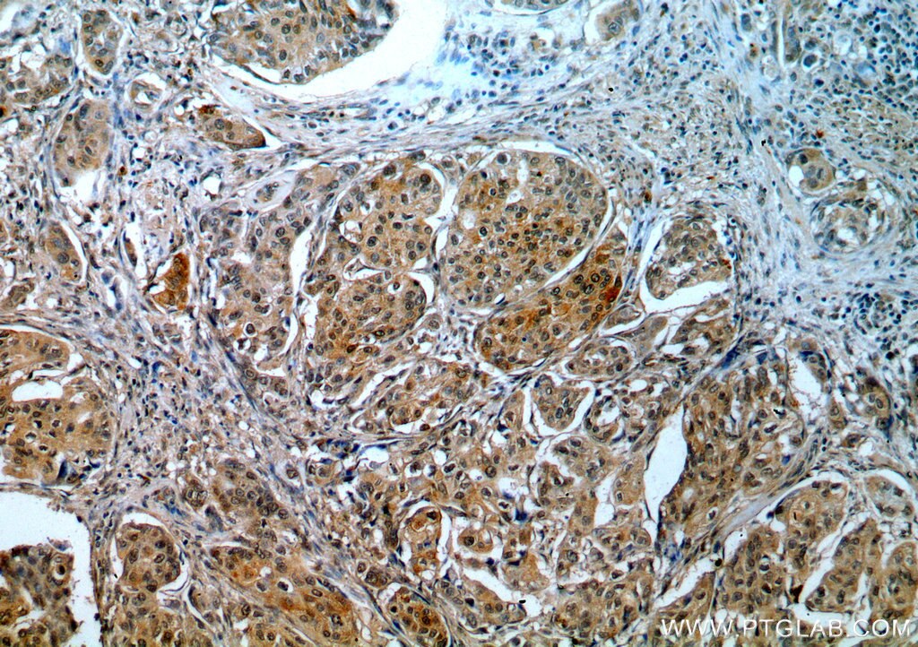 IHC staining of human cervical cancer using 18893-1-AP