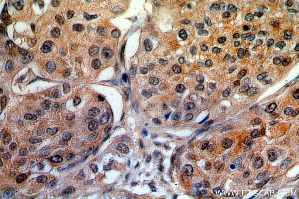 Immunohistochemistry (IHC) staining of human cervical cancer tissue using RBM16 Polyclonal antibody (18893-1-AP)