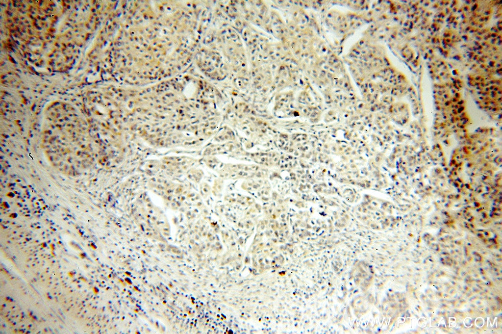 Immunohistochemistry (IHC) staining of human cervical cancer tissue using RBM16 Polyclonal antibody (18893-1-AP)