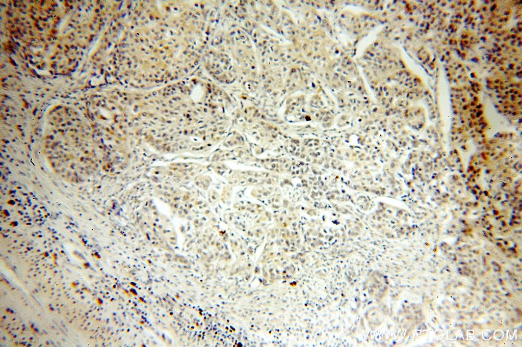 IHC staining of human cervical cancer using 18893-1-AP