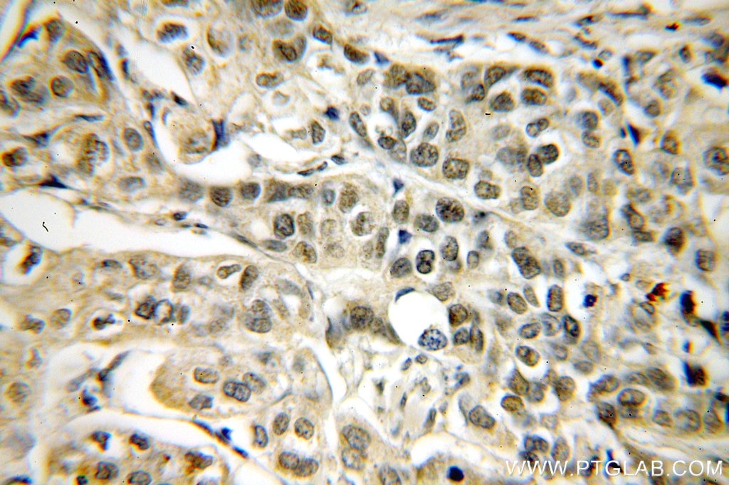 Immunohistochemistry (IHC) staining of human cervical cancer tissue using RBM16 Polyclonal antibody (18893-1-AP)