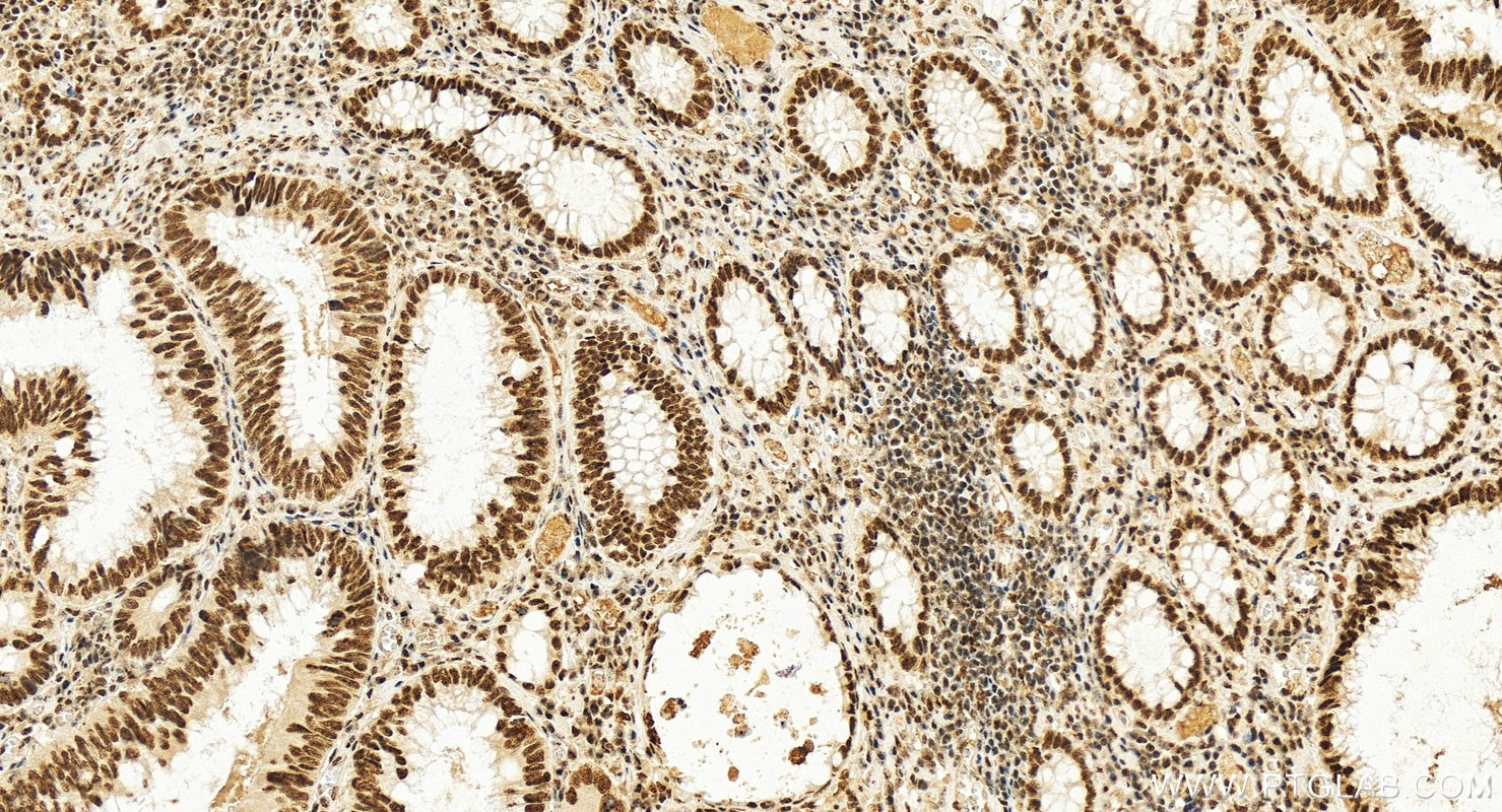 Immunohistochemistry (IHC) staining of human colon cancer tissue using RBM25 Polyclonal antibody (25297-1-AP)