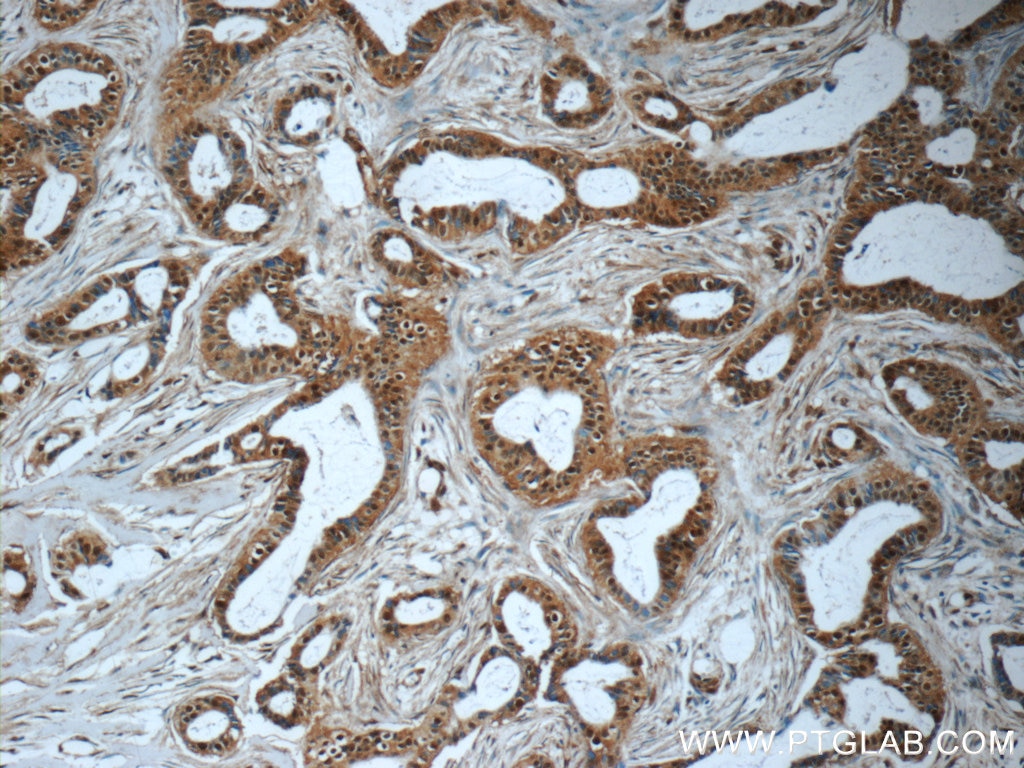 Immunohistochemistry (IHC) staining of human breast cancer tissue using RBM25 Polyclonal antibody (25297-1-AP)