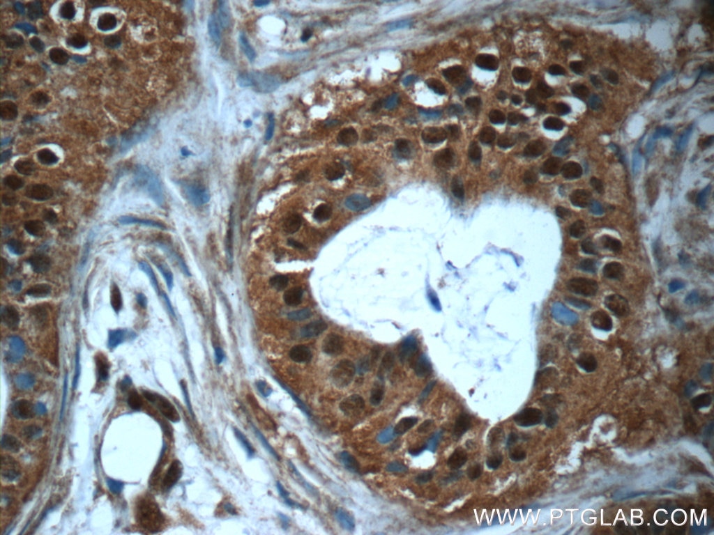 Immunohistochemistry (IHC) staining of human breast cancer tissue using RBM25 Polyclonal antibody (25297-1-AP)