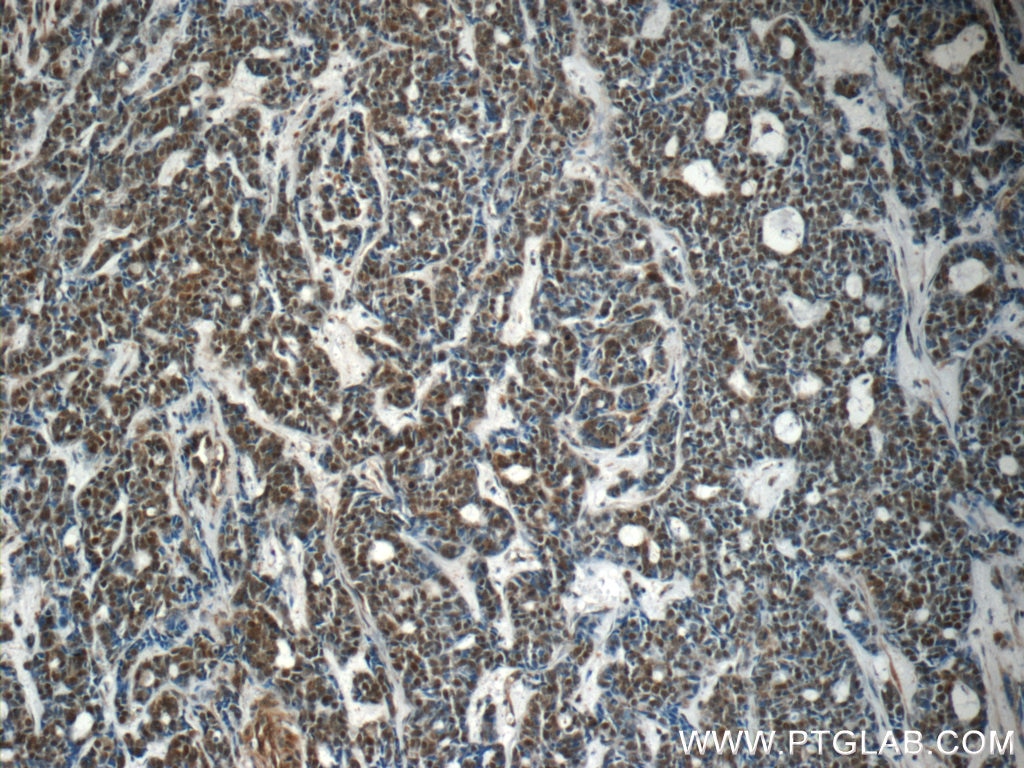 Immunohistochemistry (IHC) staining of human cervical cancer tissue using RBM25 Polyclonal antibody (25297-1-AP)