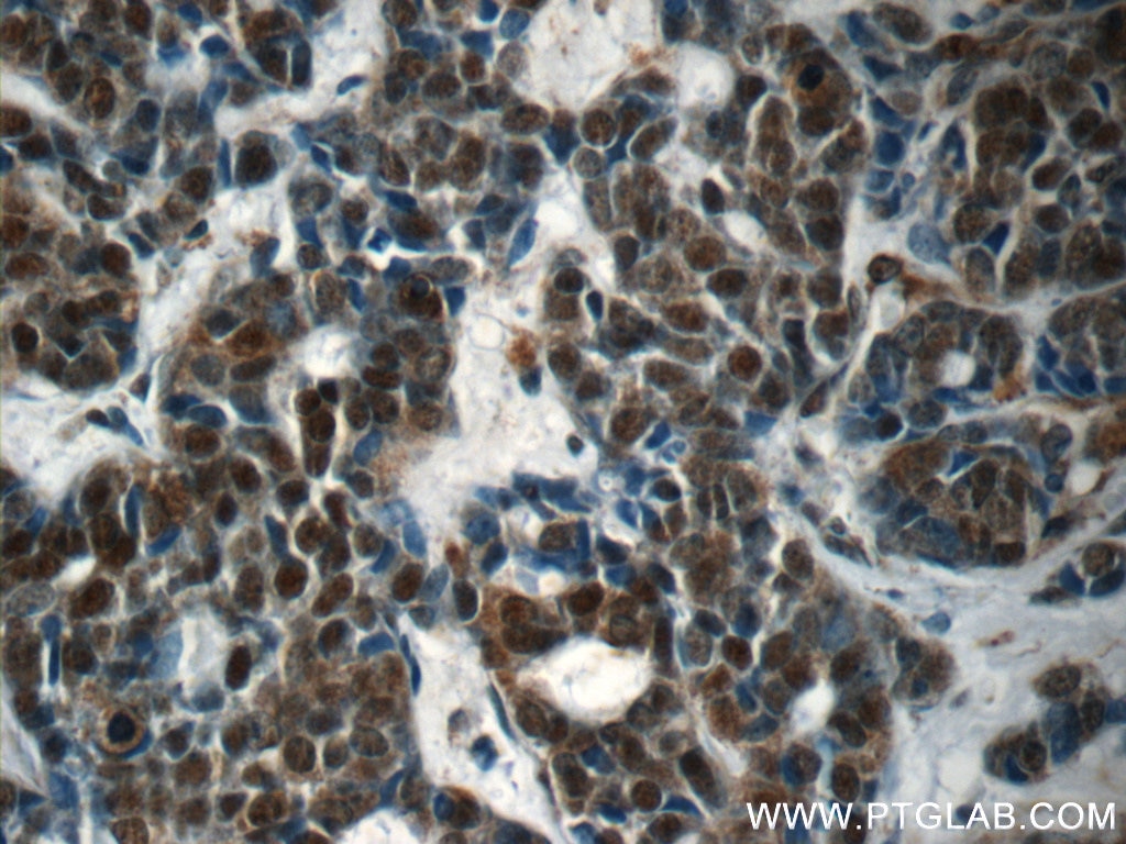 Immunohistochemistry (IHC) staining of human cervical cancer tissue using RBM25 Polyclonal antibody (25297-1-AP)