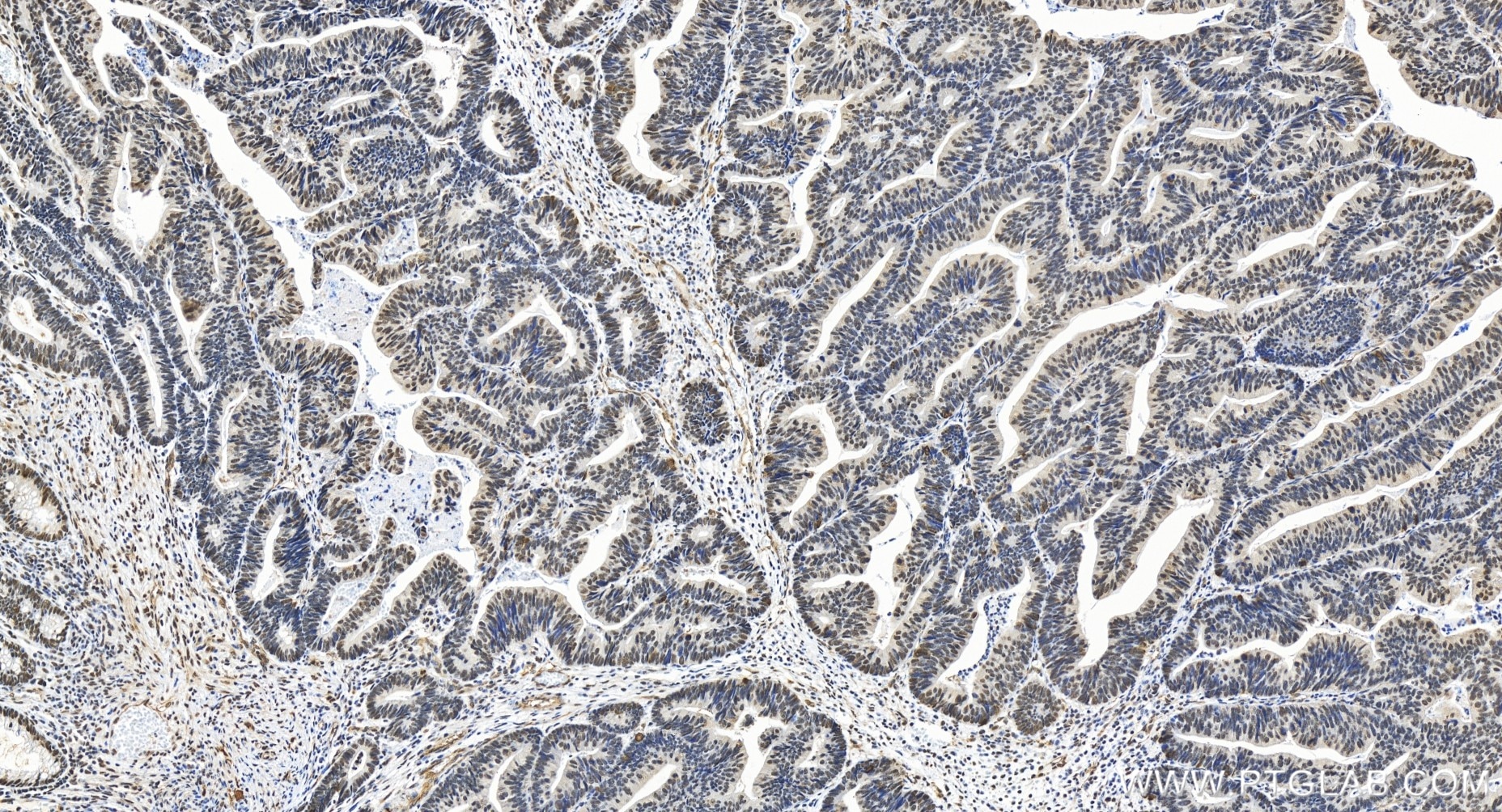 Immunohistochemistry (IHC) staining of human colon cancer tissue using RBM25 Recombinant antibody (84968-4-RR)