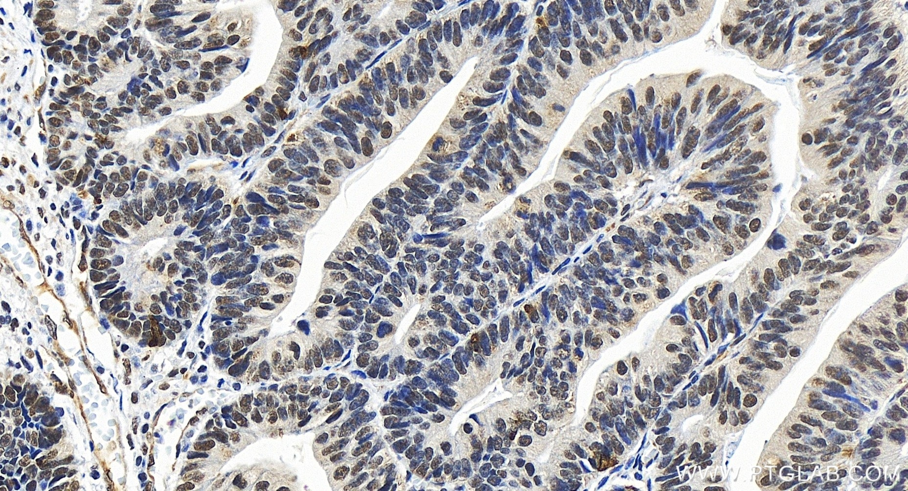 Immunohistochemistry (IHC) staining of human colon cancer tissue using RBM25 Recombinant antibody (84968-4-RR)