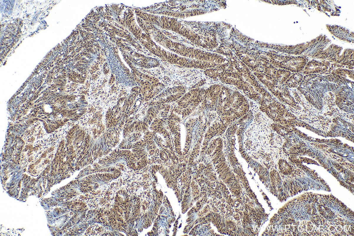 Immunohistochemistry (IHC) staining of human colon cancer tissue using Multi-rAb® RBM25 Multi-Recombinant antibody (RMX00066)