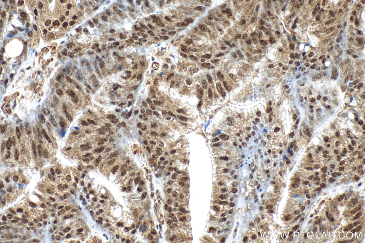 Immunohistochemistry (IHC) staining of human colon cancer tissue using Multi-rAb® RBM25 Multi-Recombinant antibody (RMX00066)
